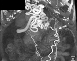 Cirrhosis With Varices as Well as Gastrostomy Tube - CTisus CT Scan