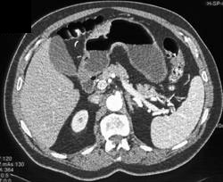 Gastric Cancer - CTisus CT Scan