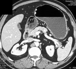 Normal Stomach - CTisus CT Scan