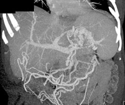 Gastric Varices - CTisus CT Scan