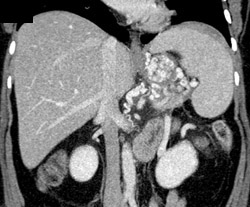 Gastric Varices - CTisus CT Scan