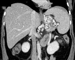 Gastric Varices - CTisus CT Scan