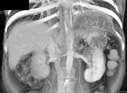 Gastric Hernia Through the Diaphragm - CTisus CT Scan