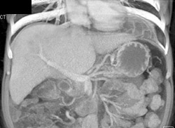 Gastric Hernia Extends Through the Diaphragm - CTisus CT Scan