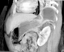 Gastric Hernia - CTisus CT Scan