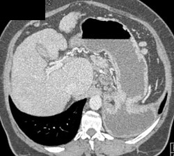 Tear in Diaphragm With Hernia of Stomach - CTisus CT Scan