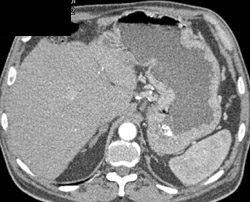 Gastritis - CTisus CT Scan