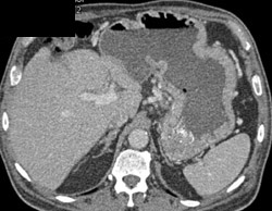 Gastritis - CTisus CT Scan