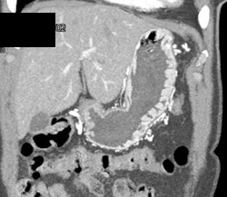 Gastritis - CTisus CT Scan