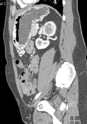 Gastritis - CTisus CT Scan