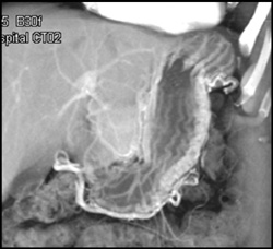 Gastritis - CTisus CT Scan