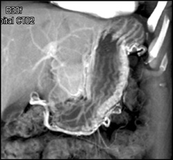 Gastritis - CTisus CT Scan