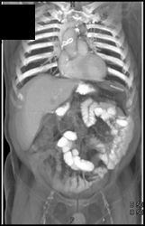 Failed Angel Chick Device - CTisus CT Scan