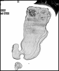 Virtual Endoscopy With Pills in Stomach - CTisus CT Scan