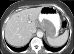 Gist - CTisus CT Scan