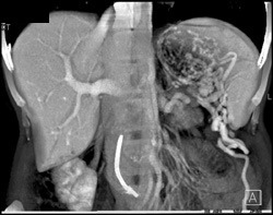 Occluded Splenic Artery With Collaterals - CTisus CT Scan