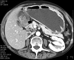 Antral Ulcer - CTisus CT Scan