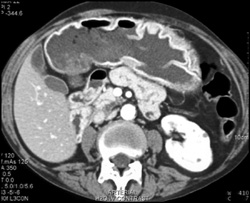 Enhancing Gastric Folds - CTisus CT Scan