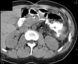 Perforated Gastric Fundus - CTisus CT Scan