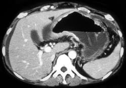 Gastric Cancer With Omental Spread - CTisus CT Scan