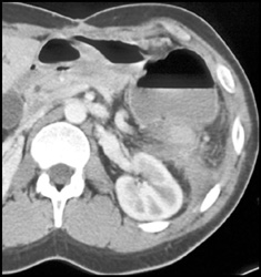 Gastro-colic Fistulae Due to Perforation - CTisus CT Scan