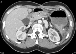 Gastro-colic Fistulae Is Hard to See W/ Oral Water Only - CTisus CT Scan