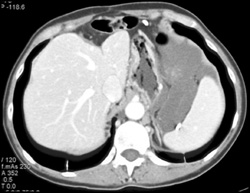 Pseudomyxoma Peritonei (PMP) - CTisus CT Scan