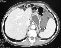 Pseudomyxoma Peritonei (PMP) - CTisus CT Scan