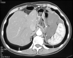 Pseudomyxoma Peritonei (PMP) - CTisus CT Scan