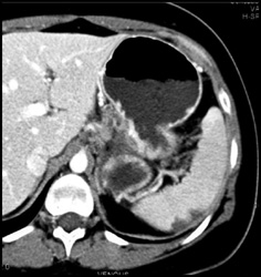 Gastric Cancer - CTisus CT Scan