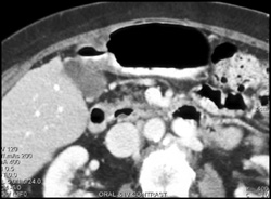 Gastric Cancer in Antrum - CTisus CT Scan