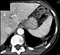 Undistended Stomach - CTisus CT Scan