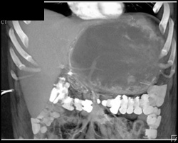 GIST Tumor - CTisus CT Scan