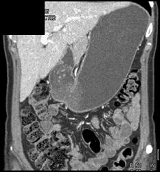 Distended Stomach - CTisus CT Scan