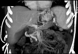 Gastric Varices - CTisus CT Scan