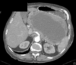 GIST Tumor - CTisus CT Scan