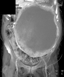 GIST Tumor - CTisus CT Scan