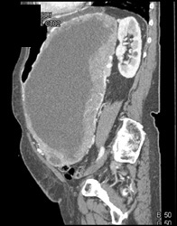 GIST Tumor - CTisus CT Scan