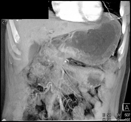 Gastric Cancer With Fistulae to Colon - CTisus CT Scan