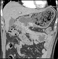 Gastric Cancer Invades Transverse Colon - CTisus CT Scan