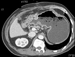 Gastric Cancer Extends Through Gastric Wall - CTisus CT Scan