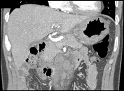 Linitis Plastica - CTisus CT Scan