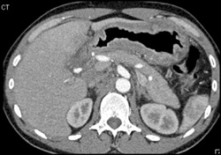 Linitis Plastica - CTisus CT Scan