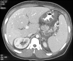 Gastritis - CTisus CT Scan