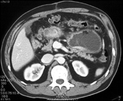 Gastric Cancer Infiltrating the Perigastric Fat - CTisus CT Scan