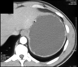 Normal Stomach - CTisus CT Scan