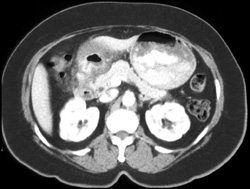 Antral Carcinoma - CTisus CT Scan