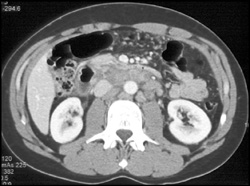 Gastric Carcinoma With Adenopathy - CTisus CT Scan