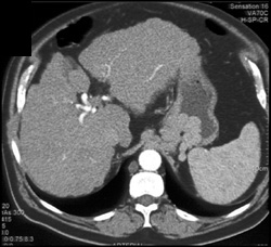 Gastric Varices - CTisus CT Scan