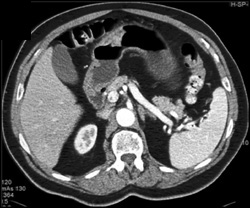 Gastric Cancer - CTisus CT Scan